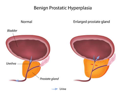 Physiology of benign prostatic hyperplasia (BPH)