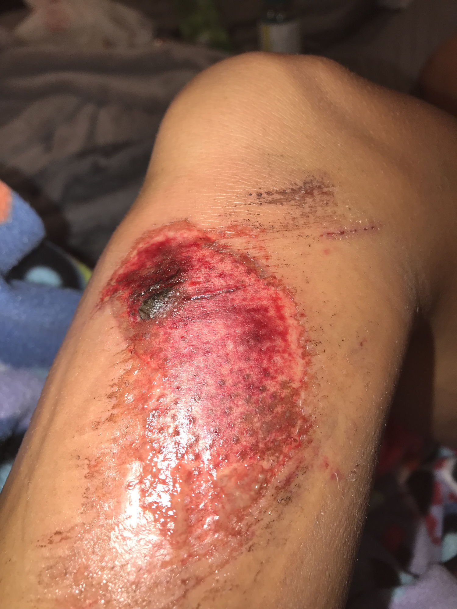 what does infected road rash look like