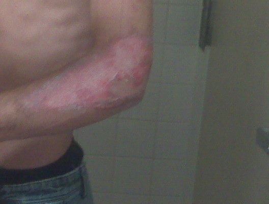 right arm