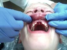 Bike wreck after dentist