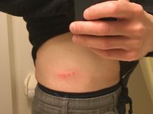 Bed bug bites - a nice parting gift