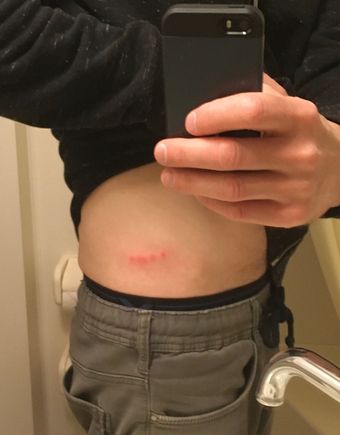 Bed bug bites - a nice parting gift