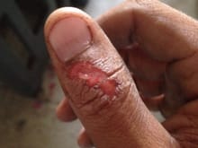 This is my thumb the day after...