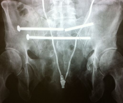 pins broke. I had t have my pelvis revised a 2nd time
