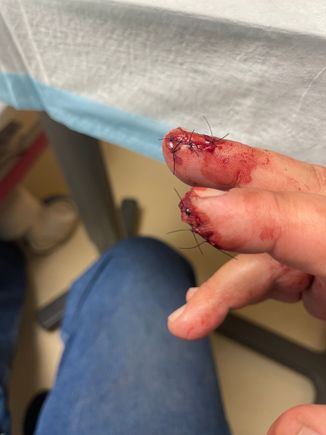 Stitched up 