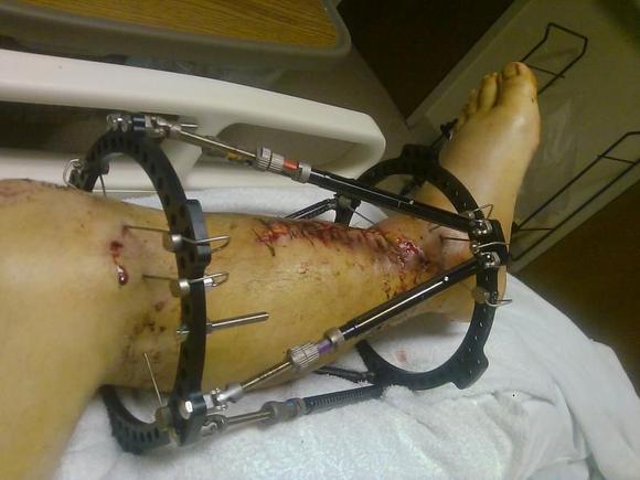 Fixator installed to grow 50mm of Tibia via stem cells harvested from my pelvis - August 2009