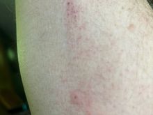 These bite. This is after being outside for about a half hour this morning. Luckily they don’t hang around all summer.