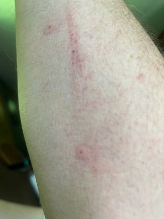 These bite. This is after being outside for about a half hour this morning. Luckily they don’t hang around all summer.