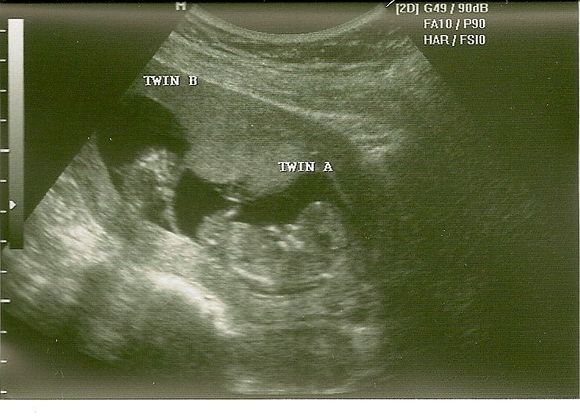 Twin A &amp; B-1.jpg